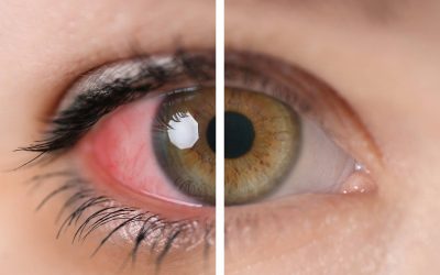 ALERGIAS OCULARES